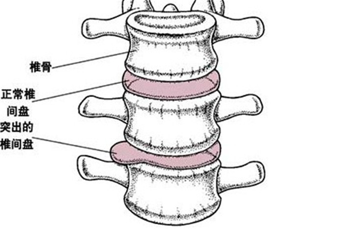 腰椎间盘突出