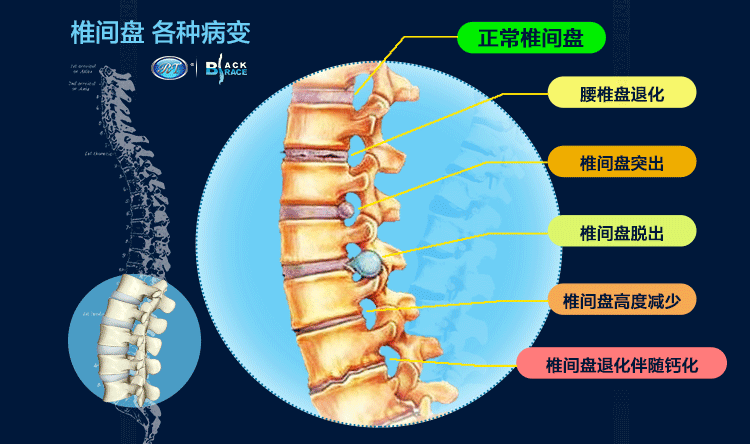 腰椎间盘突出动图